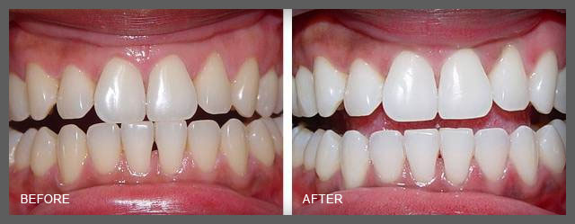 laser teeth whitening workington